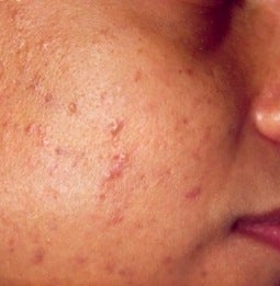 PDT for acne 