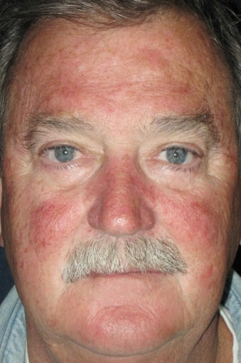 Photodynamic Therapy