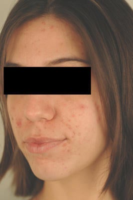 Photodynamic Therapy