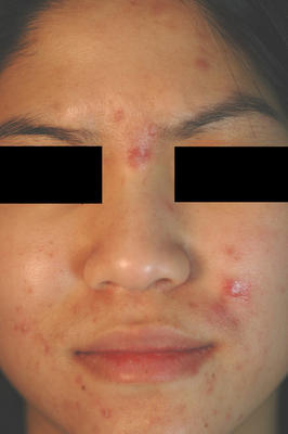Photodynamic Therapy for Acne