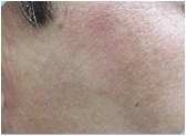 Photofacial/IPL