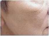 photofacial