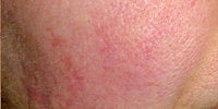 Photofacial