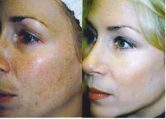 Intense Pulsed Light Treatment