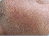 Photofacial/IPL