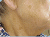 photofacial
