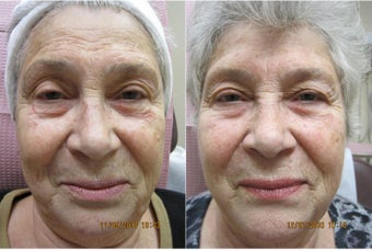 Photofacial IPL