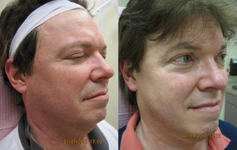 Intense pulsed light (IPL) photofacial for severe sun damage