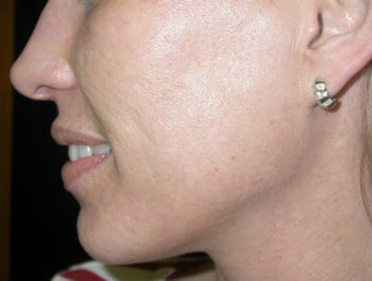 Acne scarring treatment