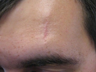 Severe, Deep Scars with Pixel