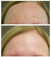 Pixel and Qs Alexandrite laser treatment