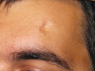 Severe, Deep Scars with Pixel
