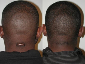Keloid Excision