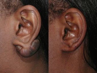 Keloid Excision