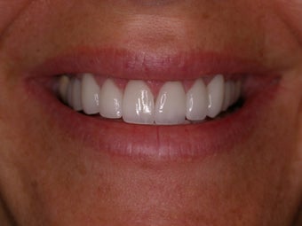 Porcelain Veneers and Porcelain Crowns