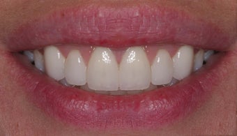 Veneer therapy