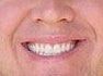 Porcelain Veneers