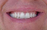 Porcelain Veneers
