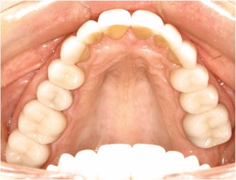 Natural All Porcelain Restorations