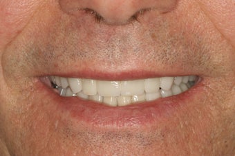Full Smile Makeover