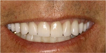 Porcelain Veneers