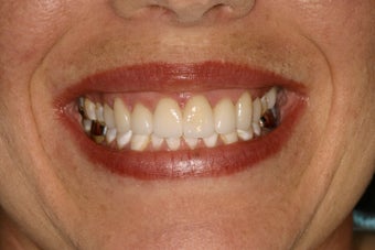 Developmental Discoloration