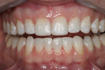 Whitening and Bonding