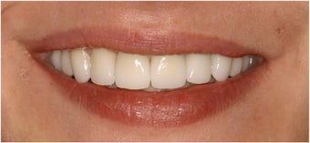 8 Veneers to a more confident smile