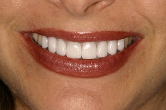 Tetracycline Stains treated with Veneers