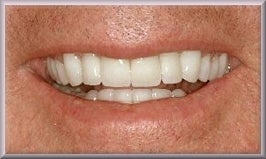Porcelain Veneers