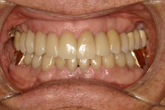 Closing black triangles between teeth