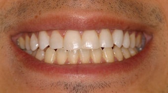 DURAthin minimal preparation porcelain veneers