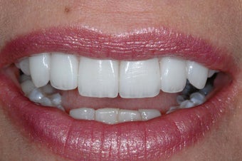 Porcelain Veneers