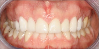 Closing Gap With Porcelain Veneers