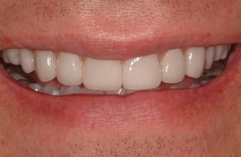 Prepless Veneers