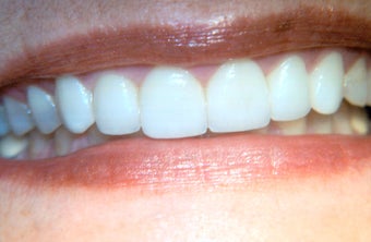 Porcelain Veneers