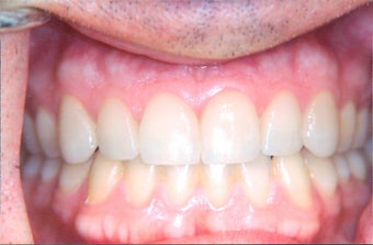 Porcelain veneers