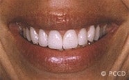 porcelain veneers