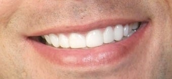 Veneers