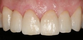 Veneers
