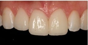 Minimal-Prep Veneers