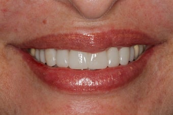 Porcelain Bridge and Veneers