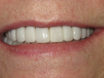 Veneers and Whitening