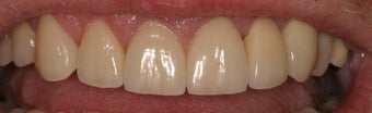Porcelain Veneers and Crowns