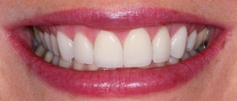 Porcelain Veneers