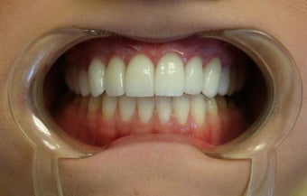 Upper arch make over with veneers and crowns