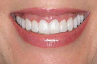 Smile Makeover: Porcelain Veneers