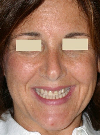Porcelain Veneers and Porcelain Crowns