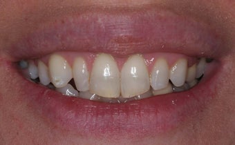 Veneer therapy