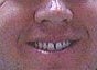 Porcelain Veneers